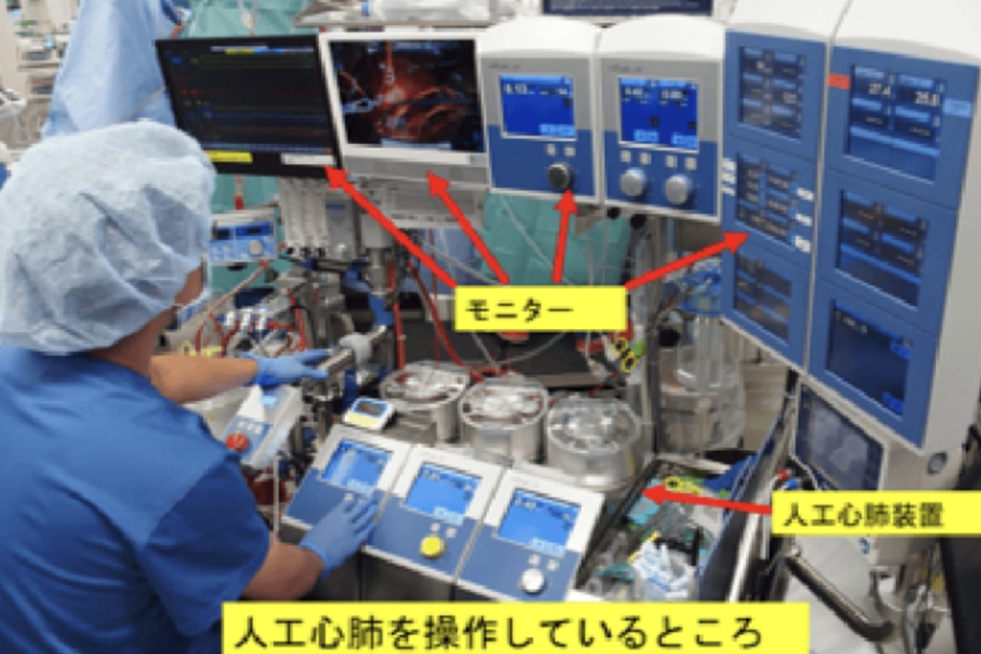 術中人工心肺操作状況